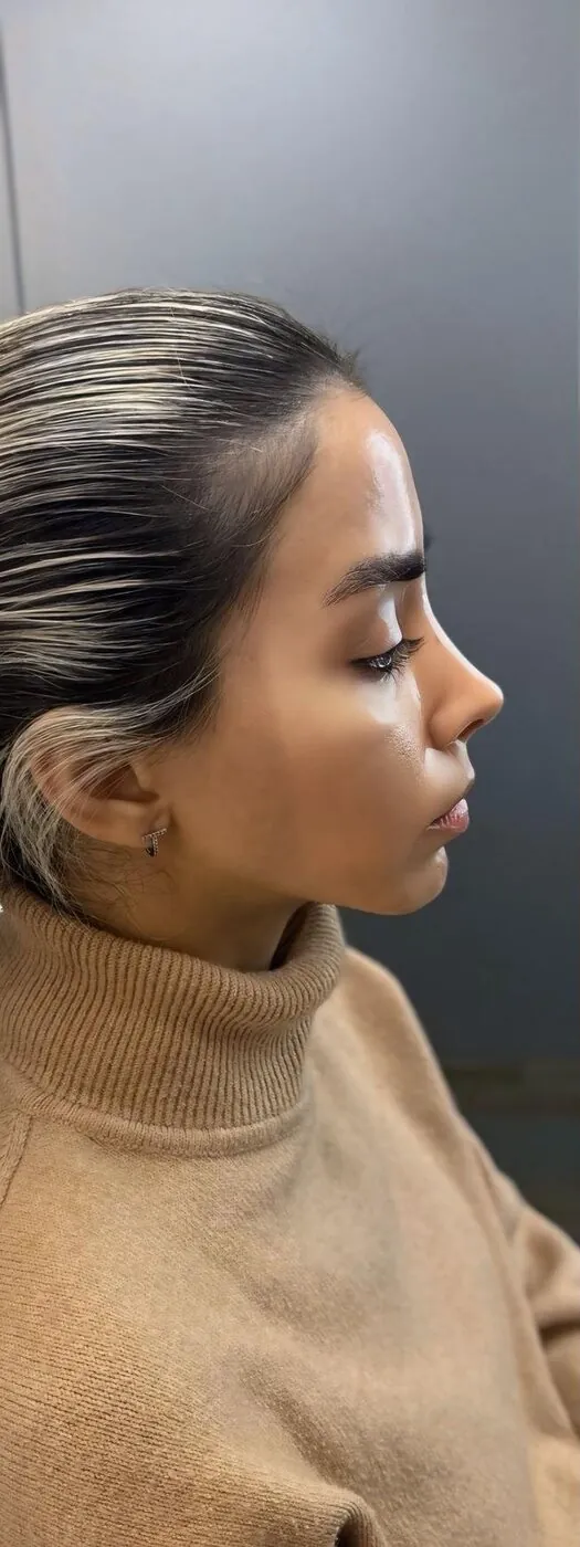 Before — Profile refinement